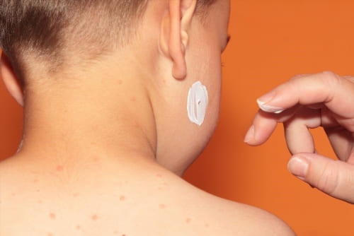 Donkere Kringen Onder Ogen Verwijderen: Dermatoloog Oplossing